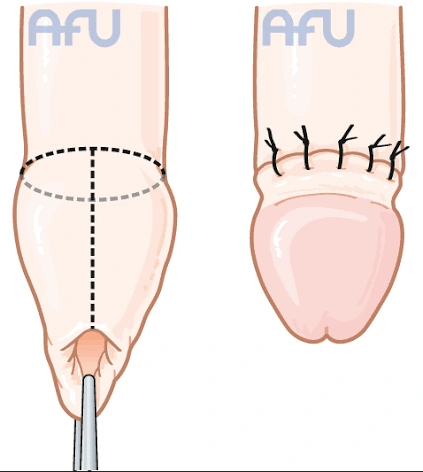 AFU : retrait du prépuce puis aspect après suture de la posthectomie.