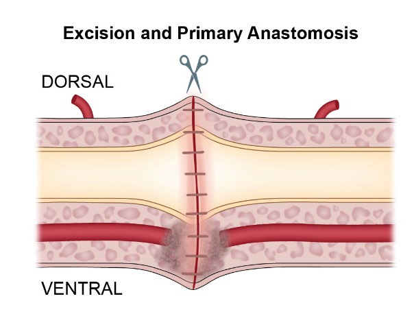 Schéma d’une suture rapprochant les deux extrémités de l’urètre après retrait du segment cicatriciel.